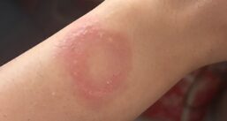 Dono de Apple Watch diz que o dispositivo causou queimadura no pulso